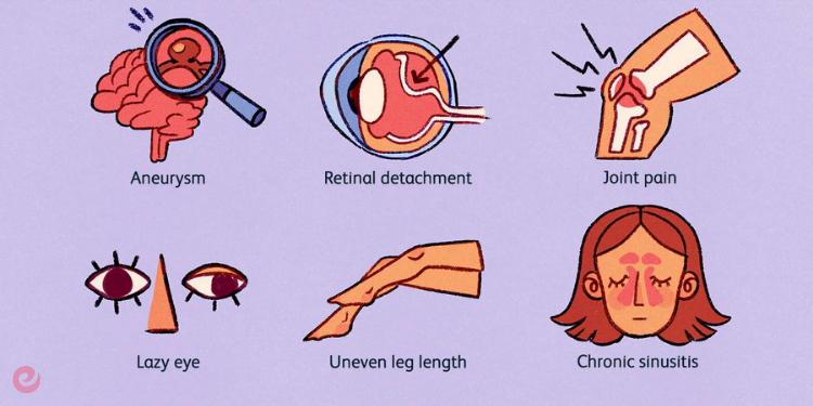 Marfan Sendromu Nedir? Marfan Sendromu Tedavisi 2 Marfan Sendromu Belirtileri Nelerdir