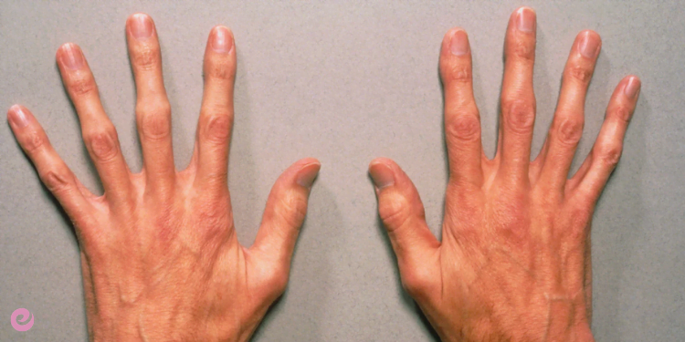 Marfan Sendromu Nedir? Marfan Sendromu Tedavisi 4 Marfan Sendromu Tedavisi Nasıldır